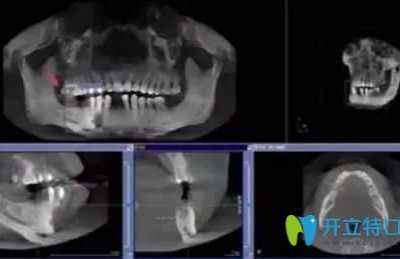植牙种植体图 看完这几张图解就知道种牙不痛苦